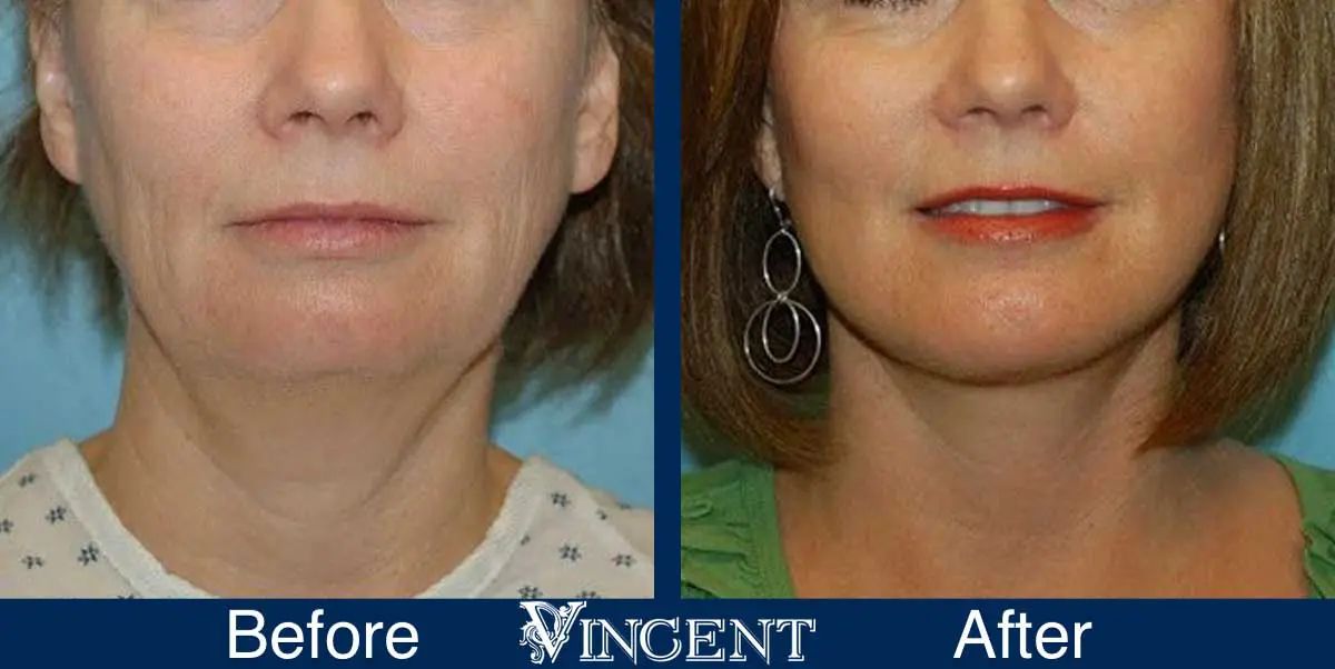 chin-implant-before-and-after-utah-0902_right
