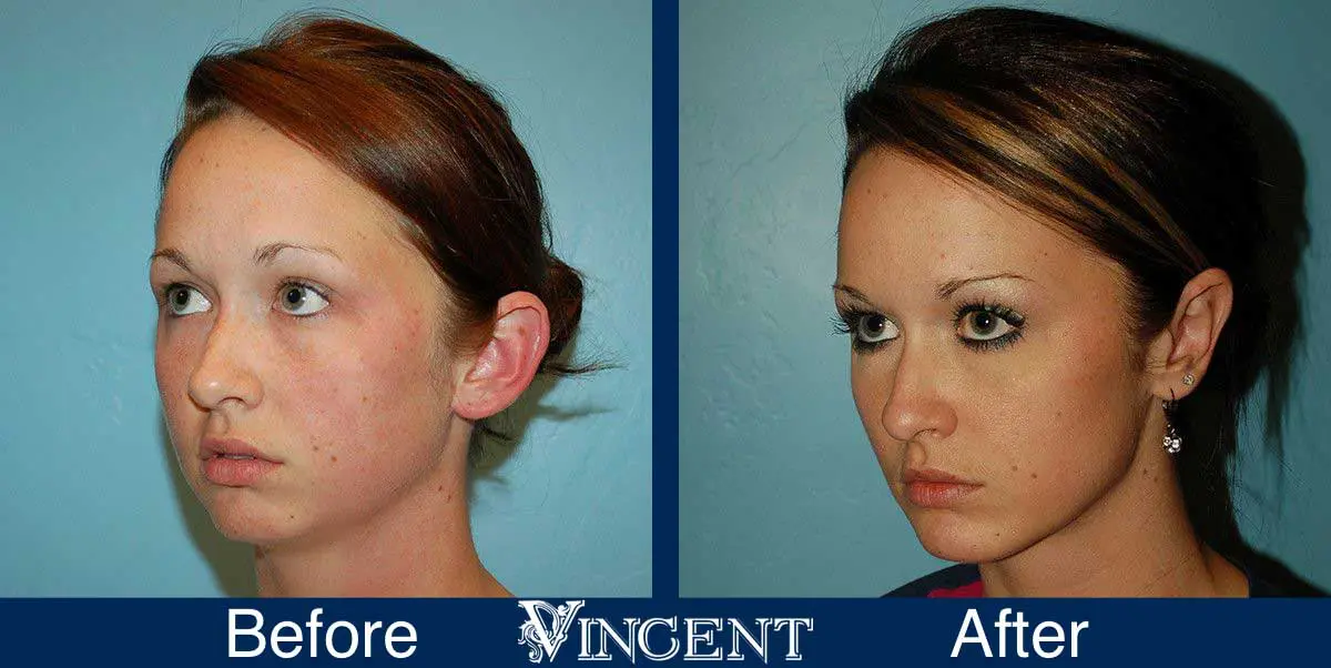 chin-implant-before-and-after-utah-0903_left1