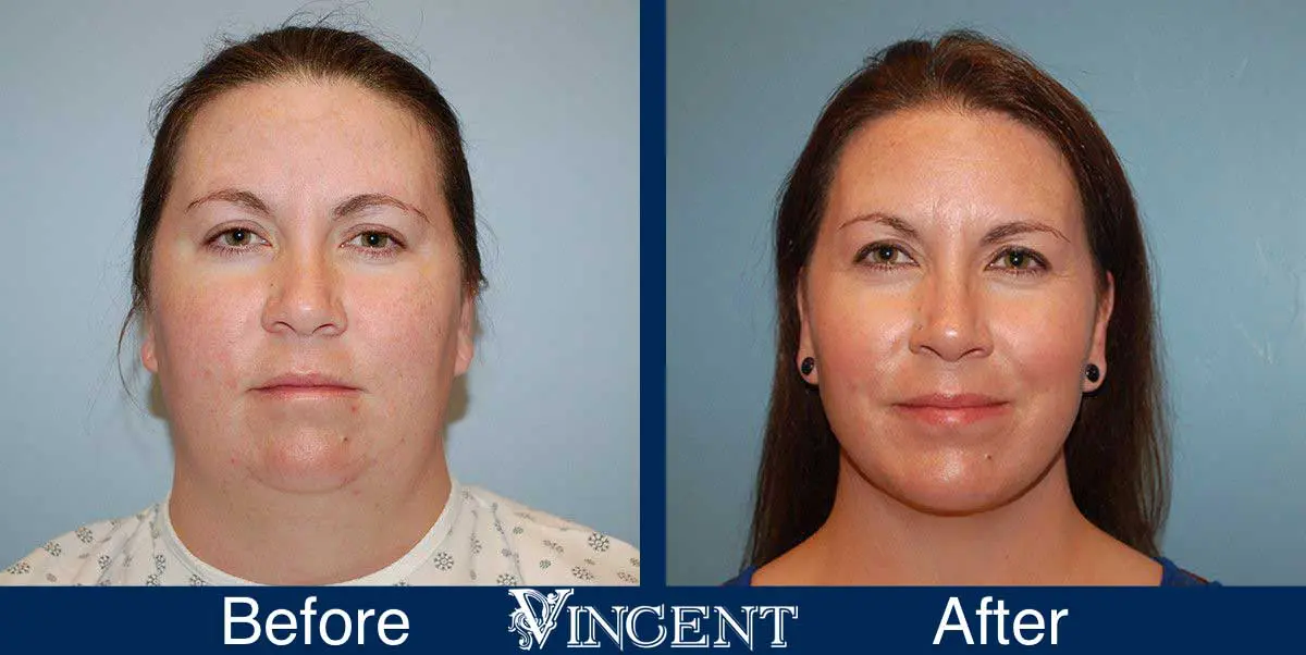 chin-implant-before-and-after-utah-0904