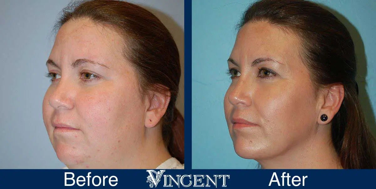chin-implant-before-and-after-utah-0904_leftside2