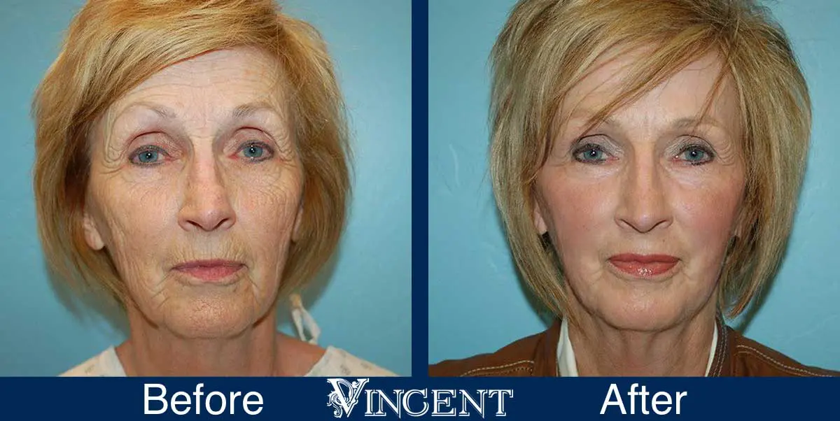 co2-laser-treatment-before-and-after-utah-vincent-surgical-arts-2002_front_fattransfer
