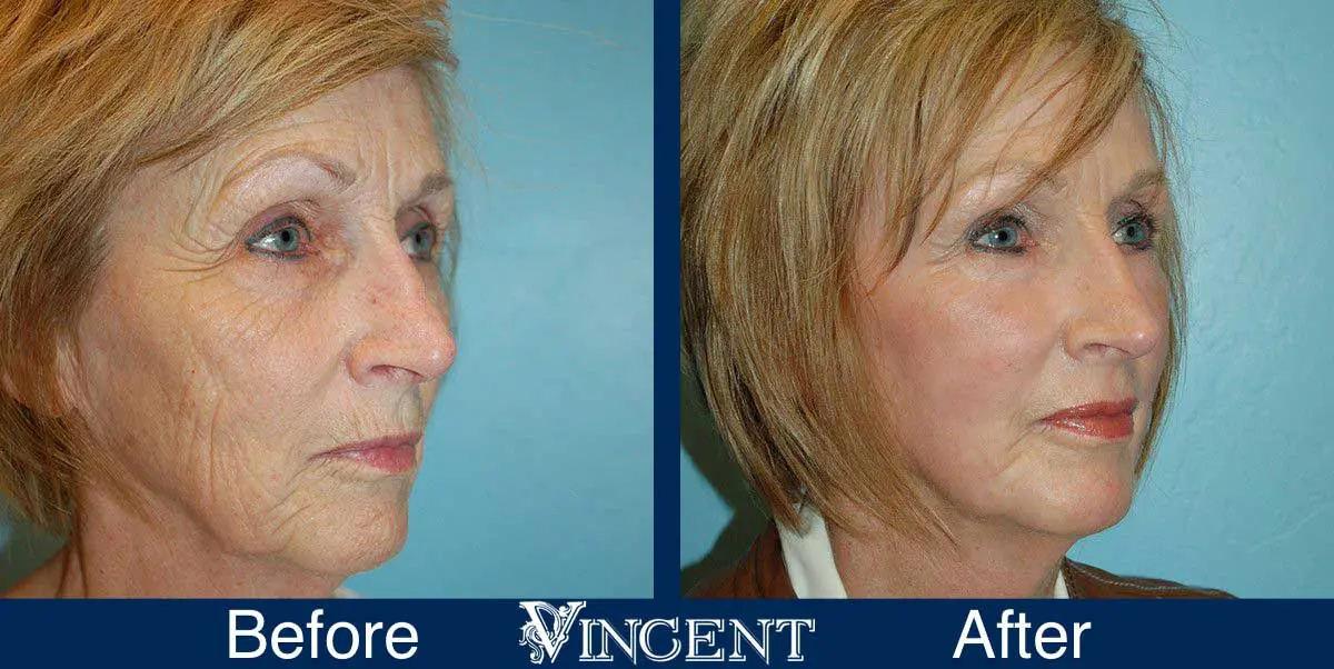 co2-laser-treatment-before-and-after-utah-vincent-surgical-arts-2002_front_fattransfer_right