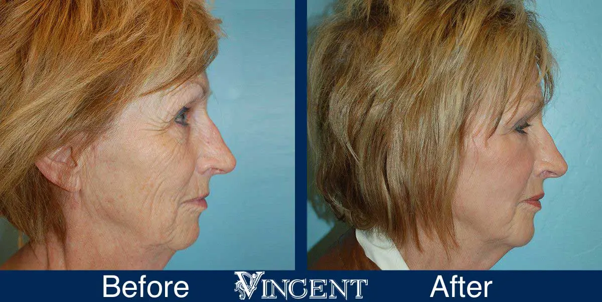 co2-laser-treatment-before-and-after-utah-vincent-surgical-arts-2002_front_fattransfer_right2