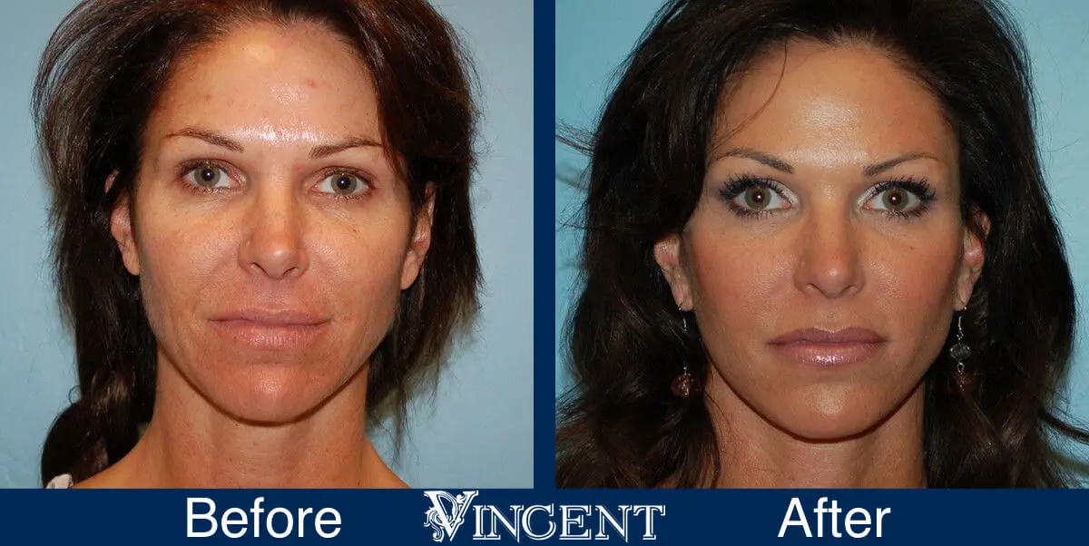 facelift-before-and-after-salt-lake-city-utah-1001-Front