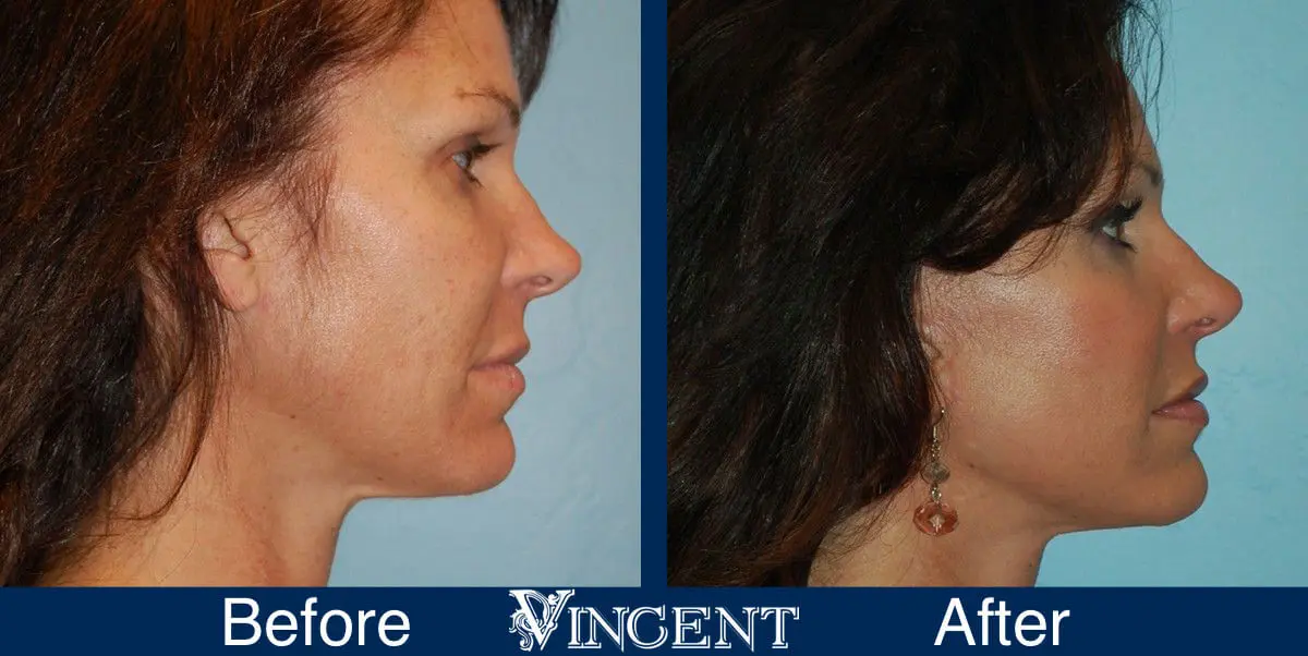 facelift-before-and-after-salt-lake-city-utah-1001-Side