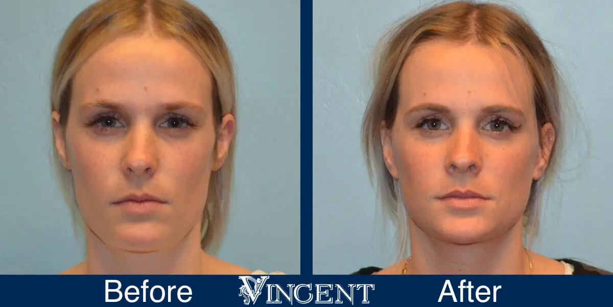 facelift-before-and-after-salt-lake-city-utah-1002_Swiftlift_front