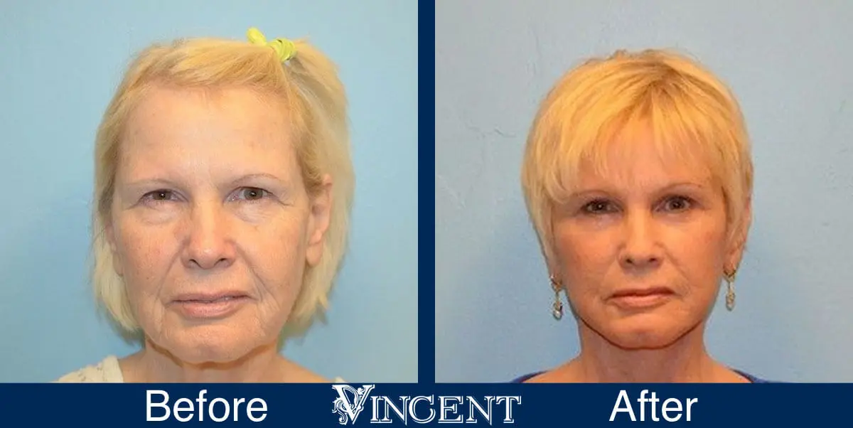 facelift-before-and-after-salt-lake-city-utah-1005-updated-front-view