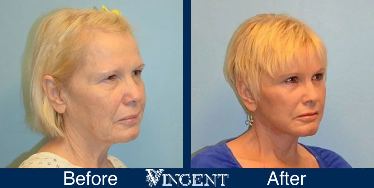 facelift-before-and-after-salt-lake-city-utah-1005-updated-right-front-view