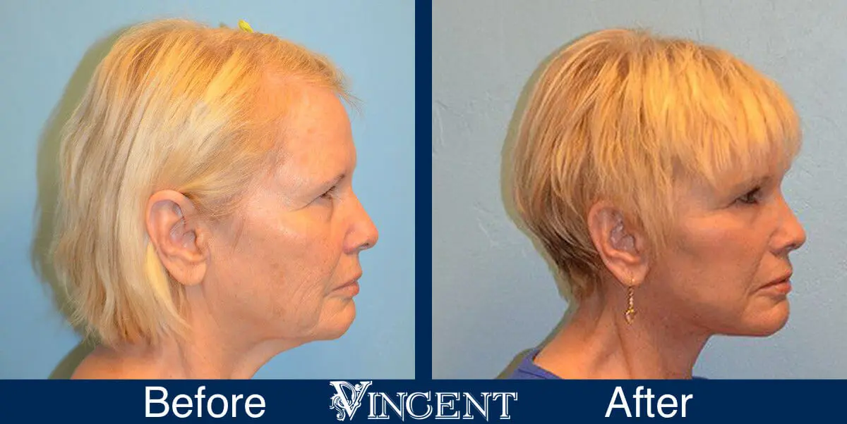 facelift-before-and-after-salt-lake-city-utah-1005-updated-right-side-view-