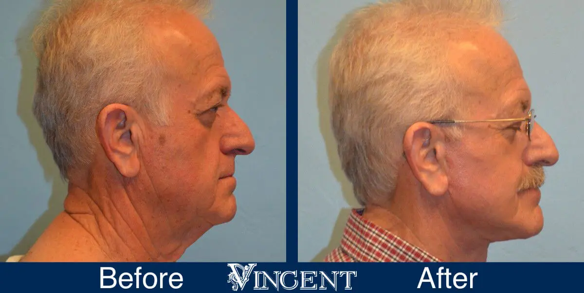 facelift-before-and-after-salt-lake-city-utah-1007_left2