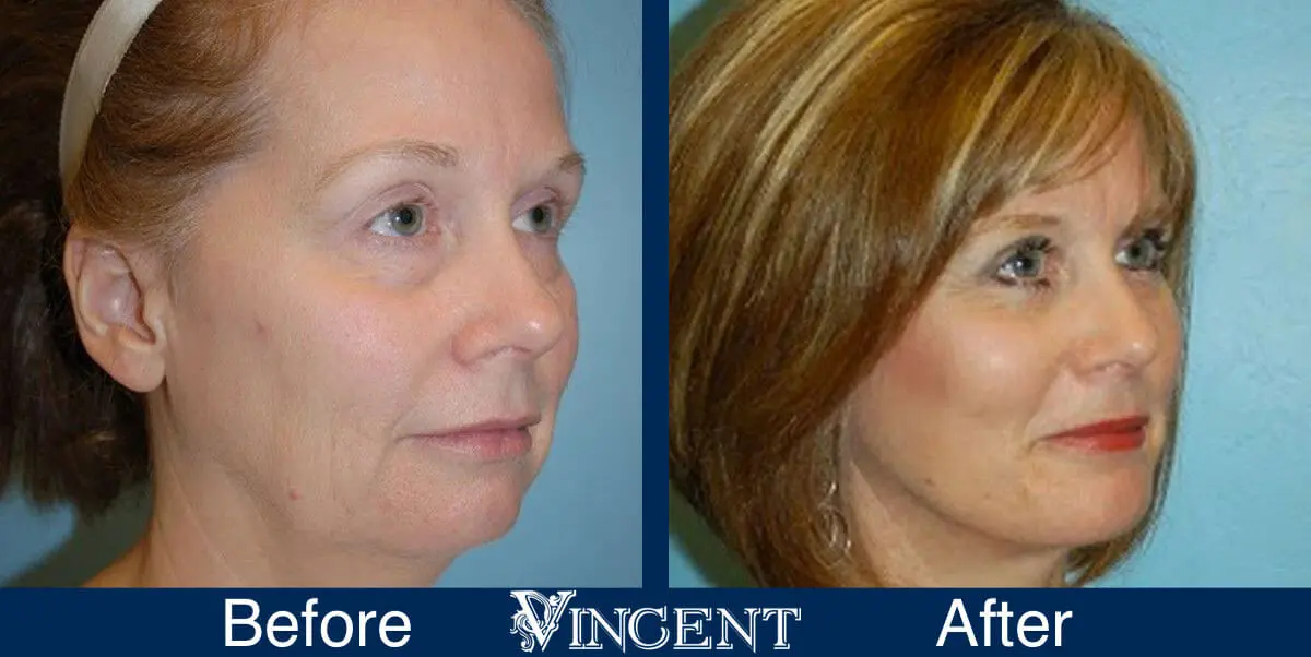 facelift-before-and-after-salt-lake-city-utah-1008_left1