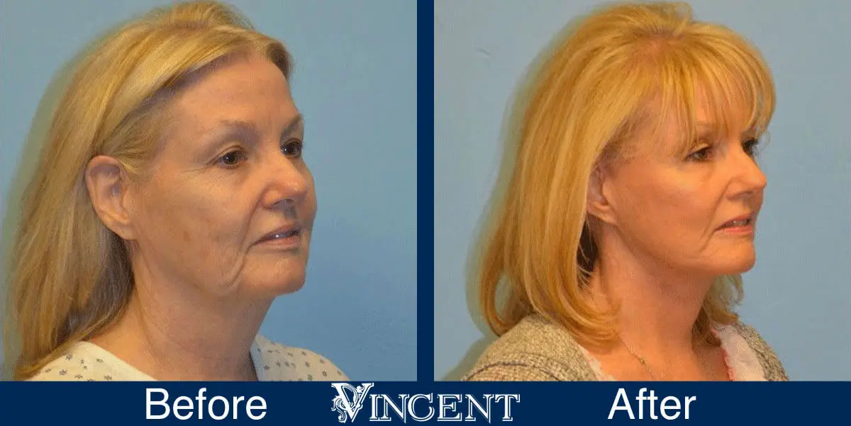 facelift-before-and-after-salt-lake-city-utah-1009_left