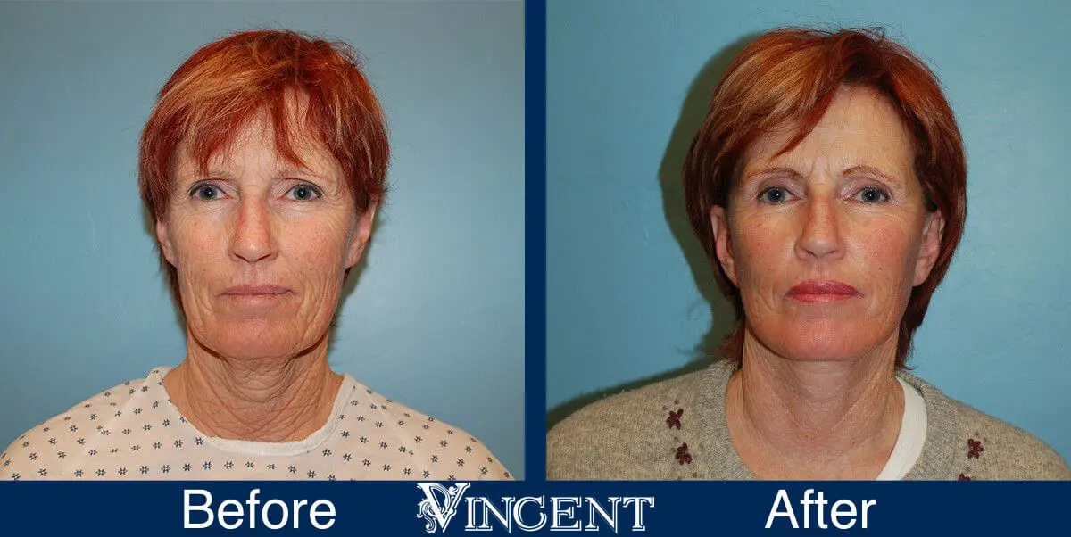 facelift-before-and-after-salt-lake-city-utah-1013_SwiftLift_w_extension_frontview-1