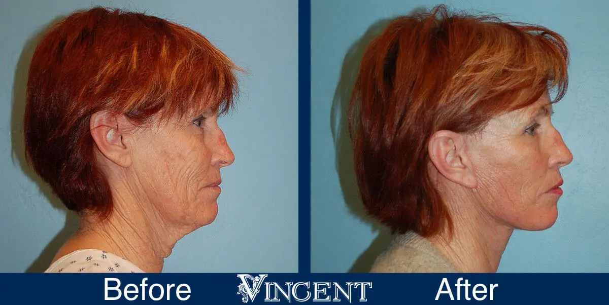 facelift-before-and-after-salt-lake-city-utah-1013_SwiftLift_w_extension_sideview-1