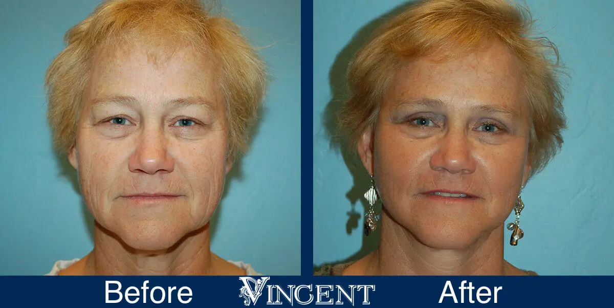 facelift-before-and-after-salt-lake-city-utah-1014_SwiftLift_w_extension_upper_blephs_front-1