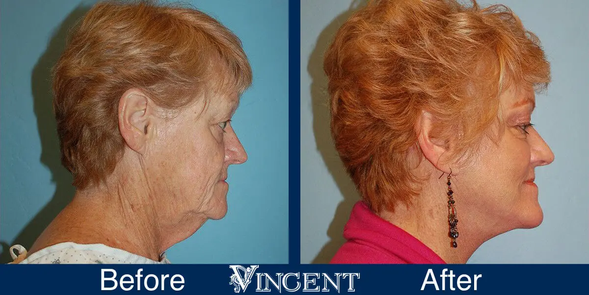 facelift-before-and-after-salt-lake-city-utah-1016_Lower_face_and_neck-lift_C02_perioral_sideview-1