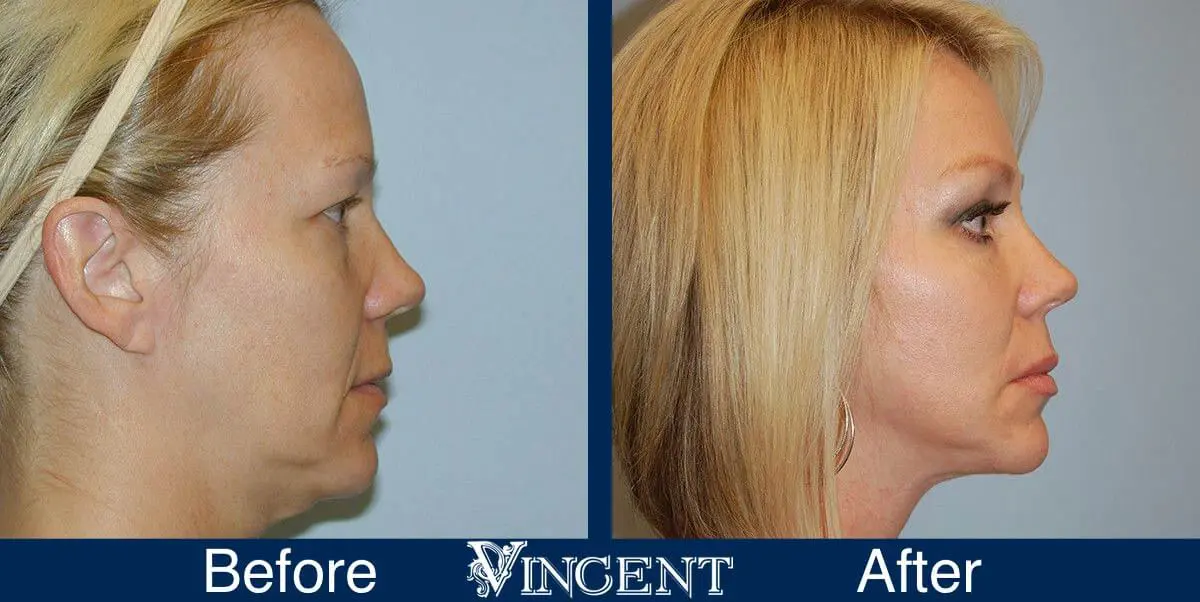 facelift-before-and-after-salt-lake-city-utah-1019_SwiftLift_upper_and_lowerblephs_fat-grafting_BBA430cc_Mastopexy_side