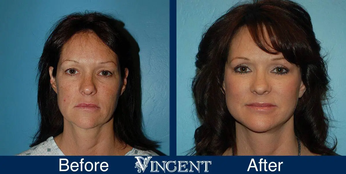 facelift-before-and-after-salt-lake-city-utah-1021_SwiftLift_w_extension_front