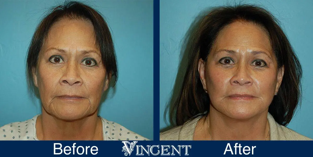 facelift-before-and-after-salt-lake-city-utah-1026_SwiftLift_w_extension_Drake_Vincent_frontview