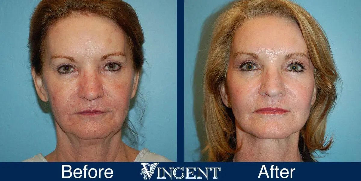 facelift-before-and-after-salt-lake-city-utah-1027_SwiftLift_w_Browlift_Drake_Vincent_frontview