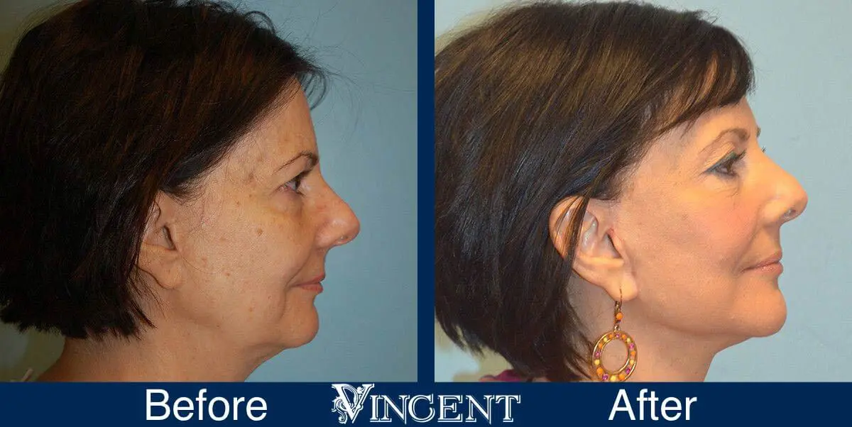 facelift-before-and-after-salt-lake-city-utah-1028_SwiftLift_w_Extension_Drake_Vincent_sideview