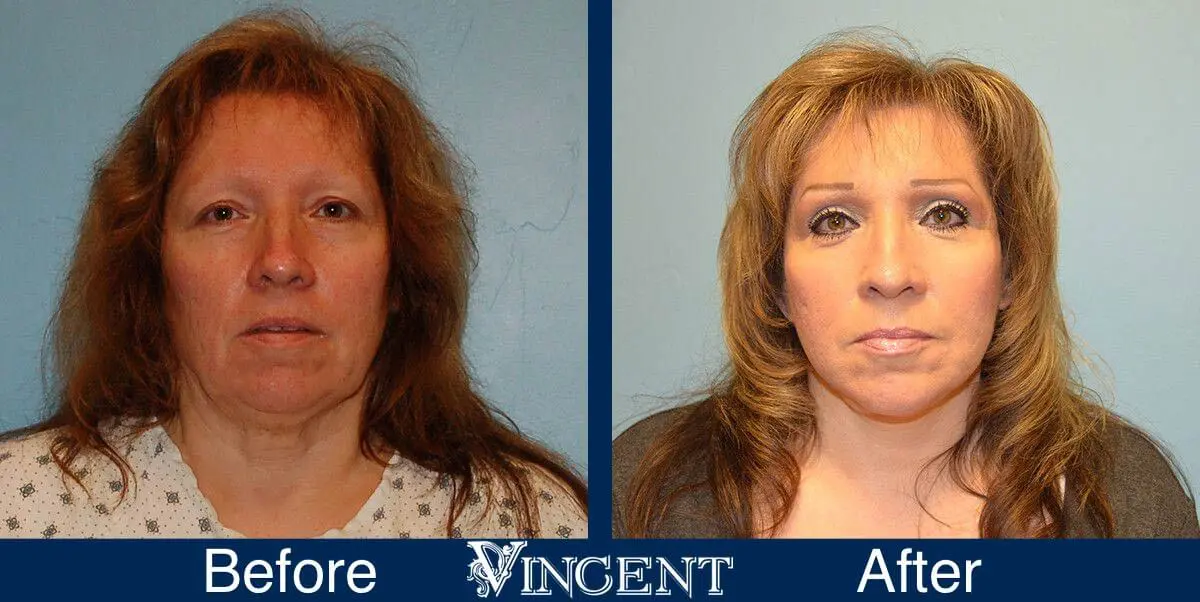 facelift-before-and-after-salt-lake-city-utah-1033_SwiftLift_upper_and_lower_blephs_Submental_lipo_chemical_peel_on (1)