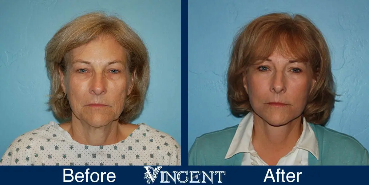 facelift-before-and-after-salt-lake-city-utah-1035_Swiftlift-4