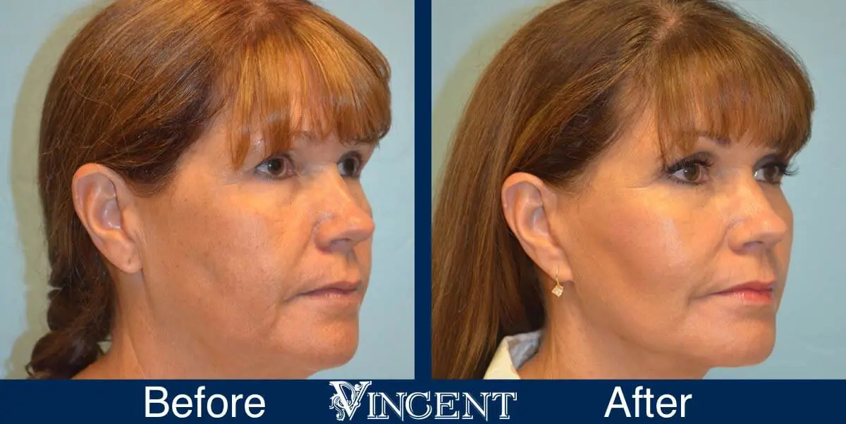 facelift-before-and-after-salt-lake-city-utah-1036_Swiftlift-6