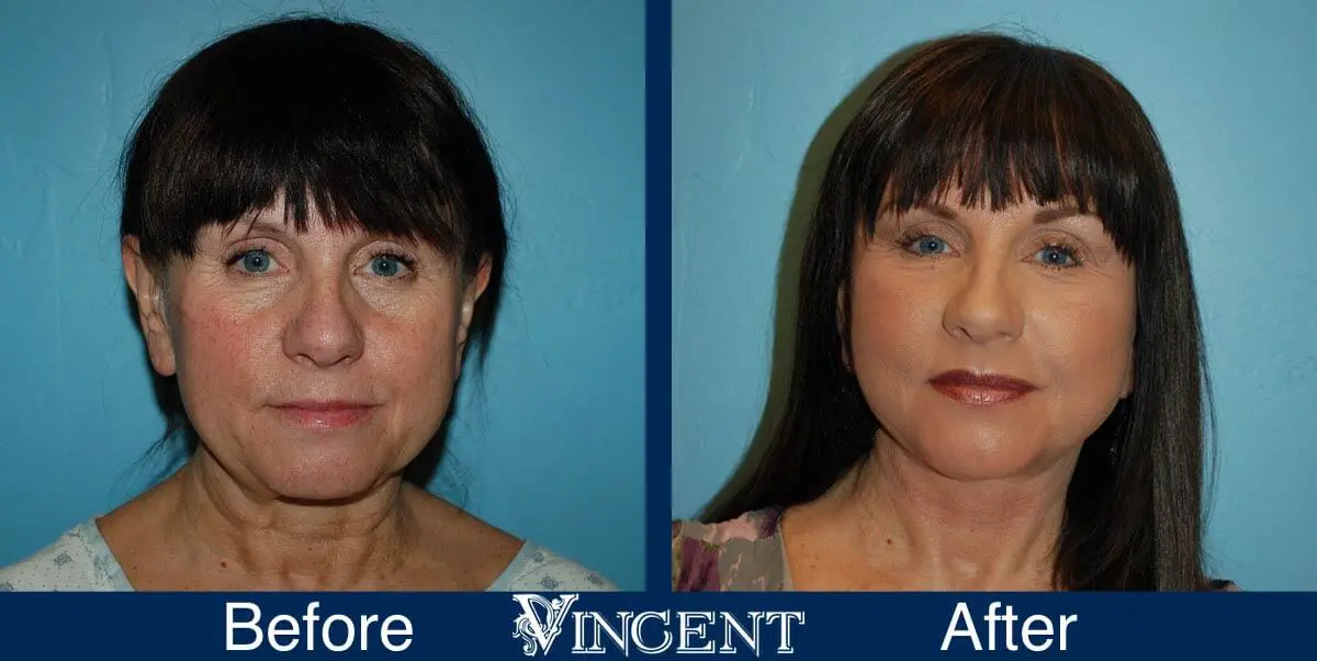 facelift-before-and-after-salt-lake-city-utah-1037_Swiftlift-8