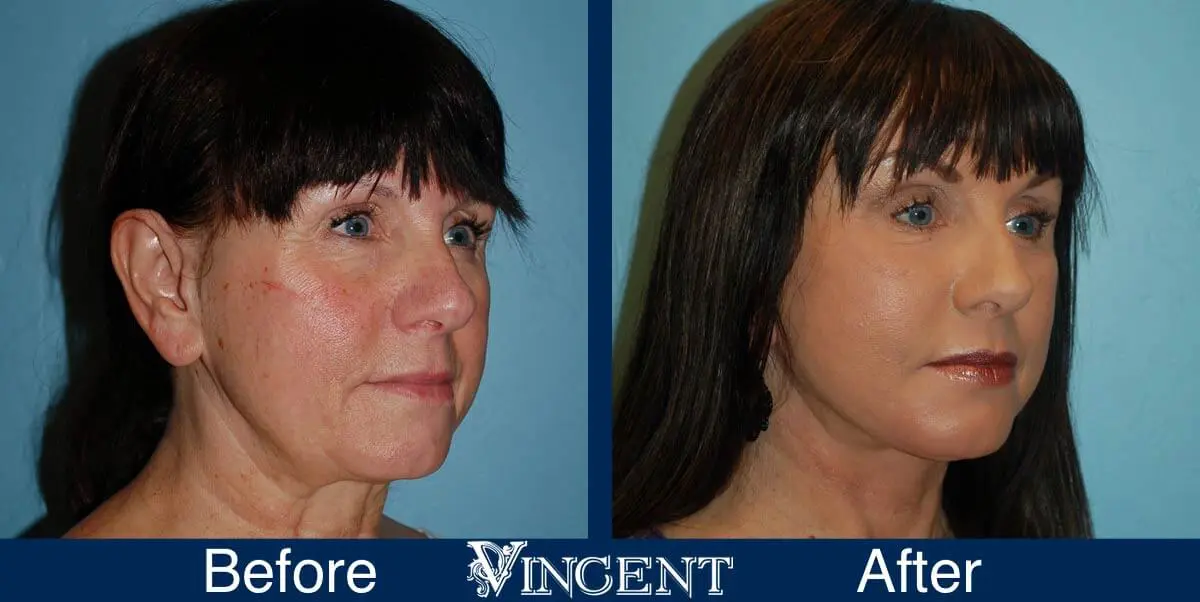 facelift-before-and-after-salt-lake-city-utah-1037_Swiftlift-9