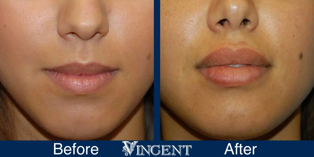 lip-augmentation-before-and-after-utah-vincent-surgical-arts-0901_lip_aug_front