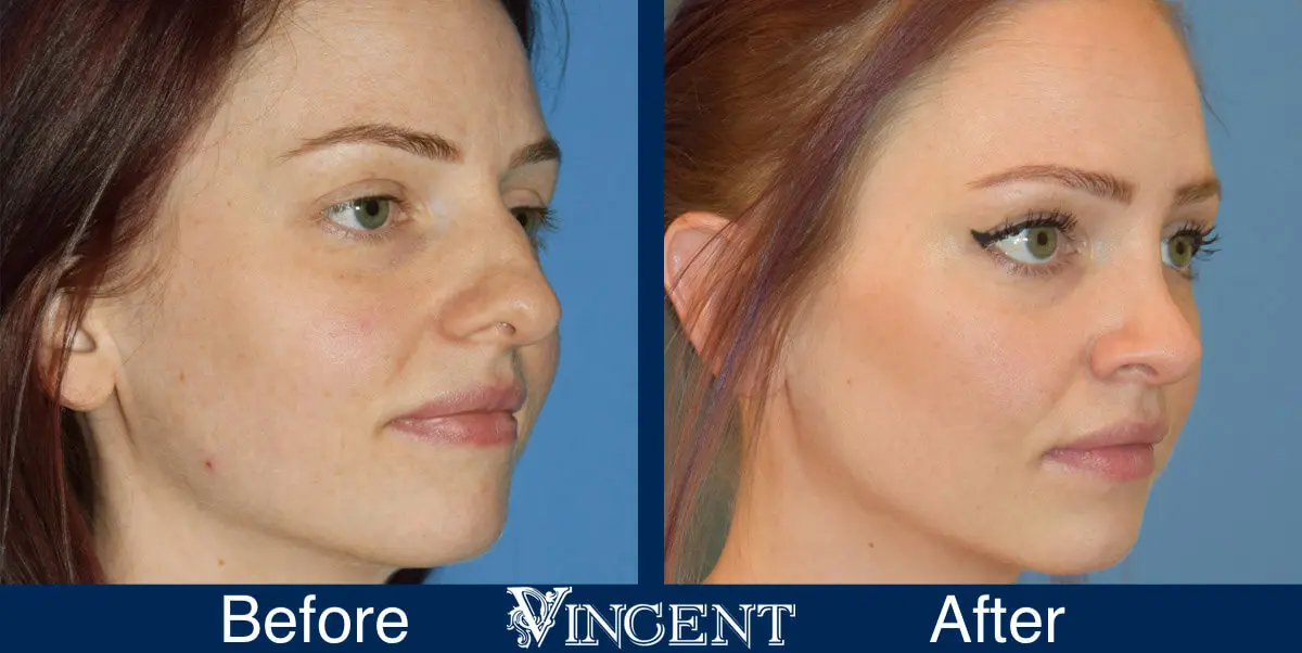 nose-job-before-and-after-female-salt-lake-city-utah-right-2