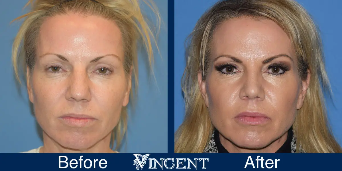 nose-job-before-and-after-female-utah-front-1-2