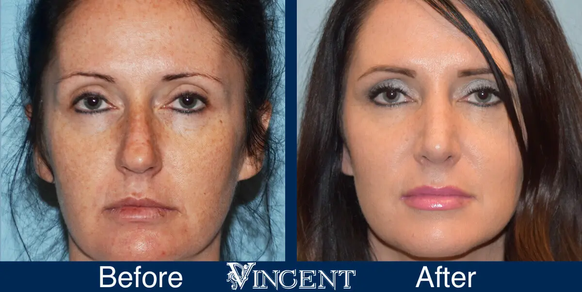 nose-job-before-and-after-female-utah-front-1