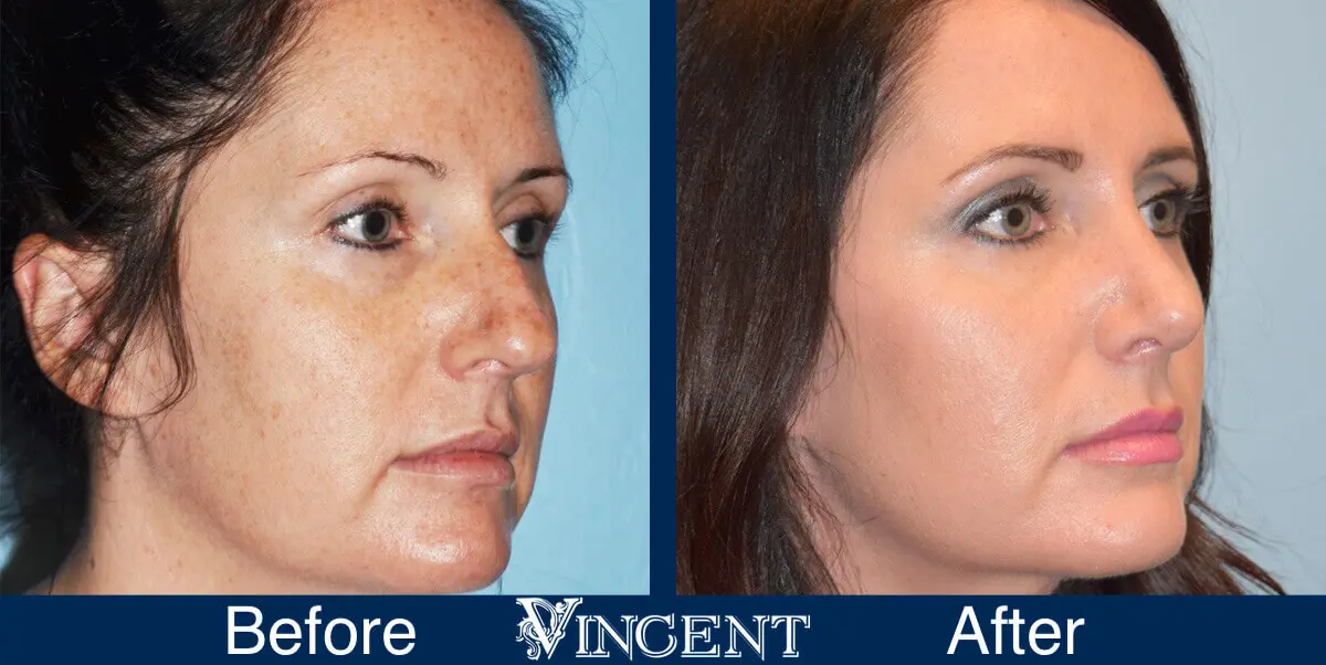 nose-job-before-and-after-female-utah-right-2