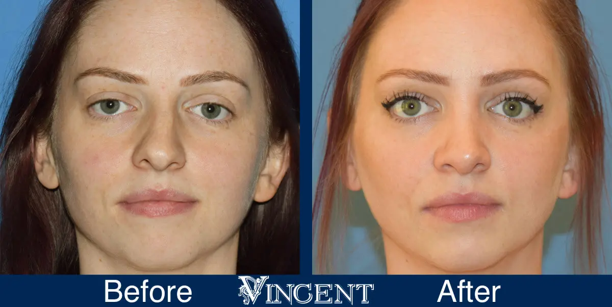 nose-job-before-and-after-female-utah-salt-lake-city-front-1-1