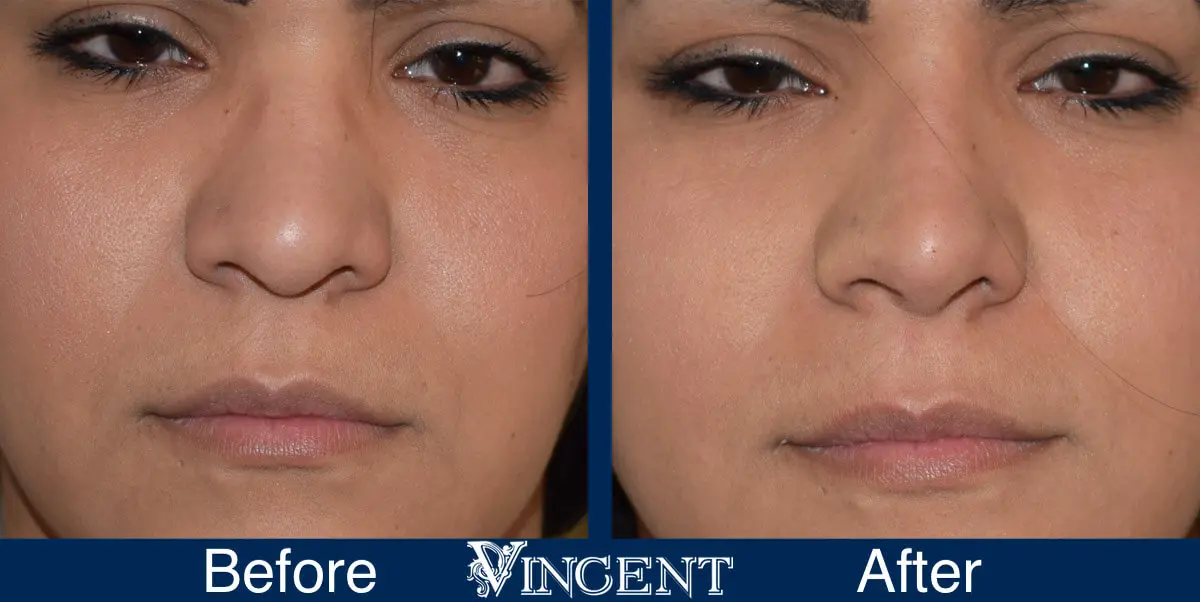 rhinoplasty-before-and-after-female-utah-salt-lake-city-front-1