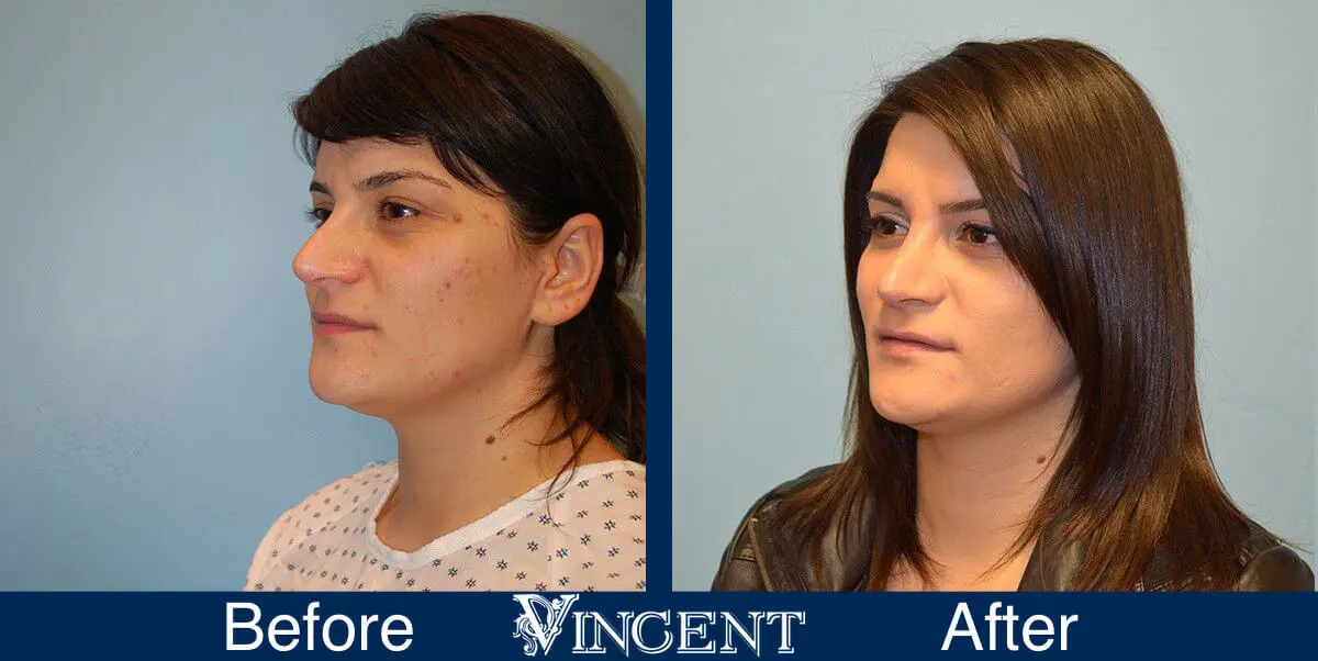 rhinoplasty-nose-job-salt-lake-city-utah-4501-front-left