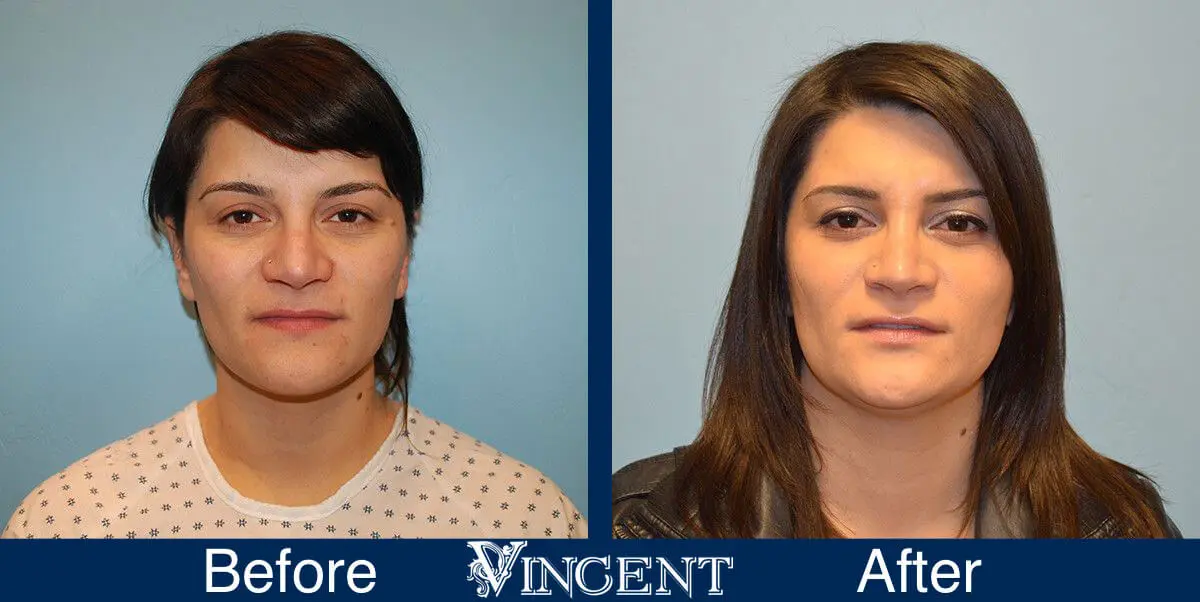 rhinoplasty-nose-job-salt-lake-city-utah-4501-front