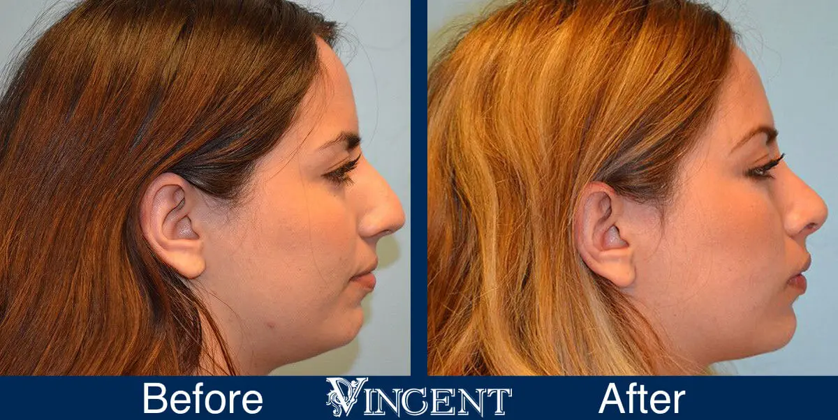 rhinoplasty-nose-job-salt-lake-city-utah-4502-3