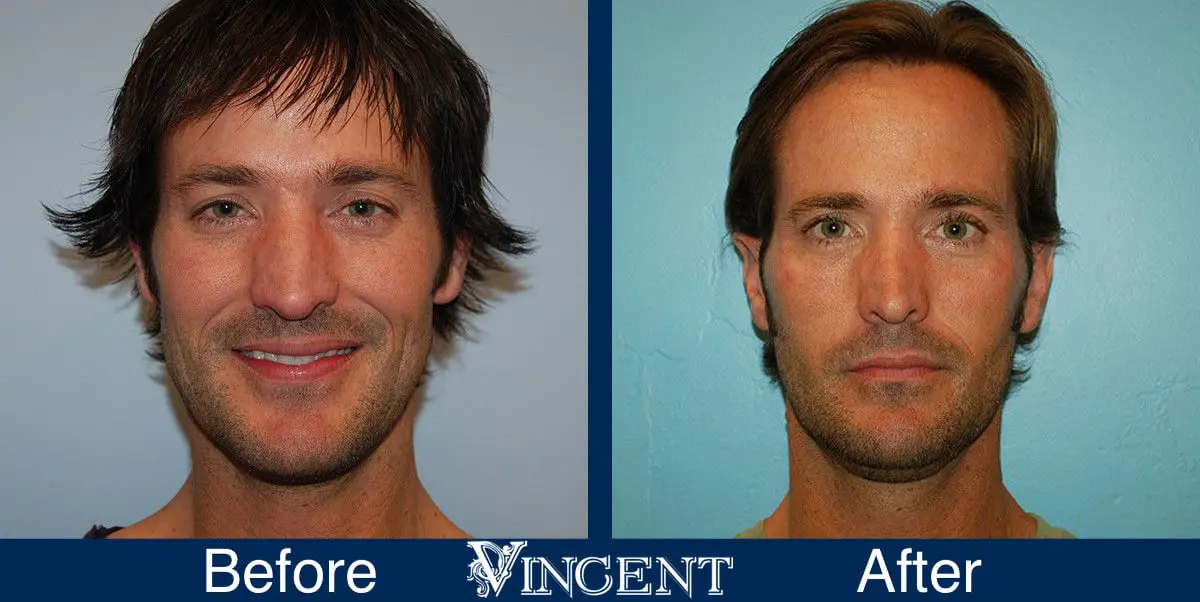 rhinoplasty-nose-job-salt-lake-city-utah-4503-front-1