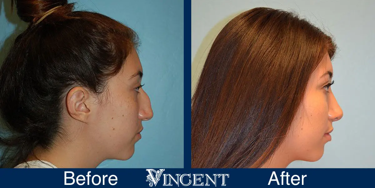 rhinoplasty-nose-job-salt-lake-city-utah-4505-3