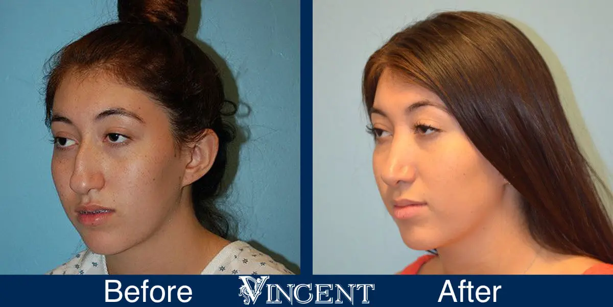 rhinoplasty-nose-job-salt-lake-city-utah-4505-4