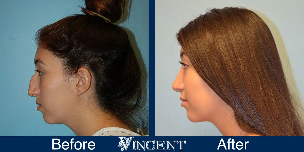 rhinoplasty-nose-job-salt-lake-city-utah-4505-5