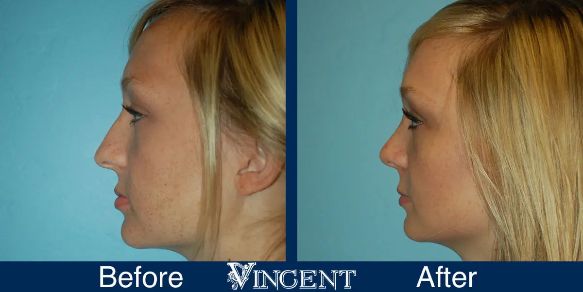 rhinoplasty-nose-job-salt-lake-city-utah-4513-4