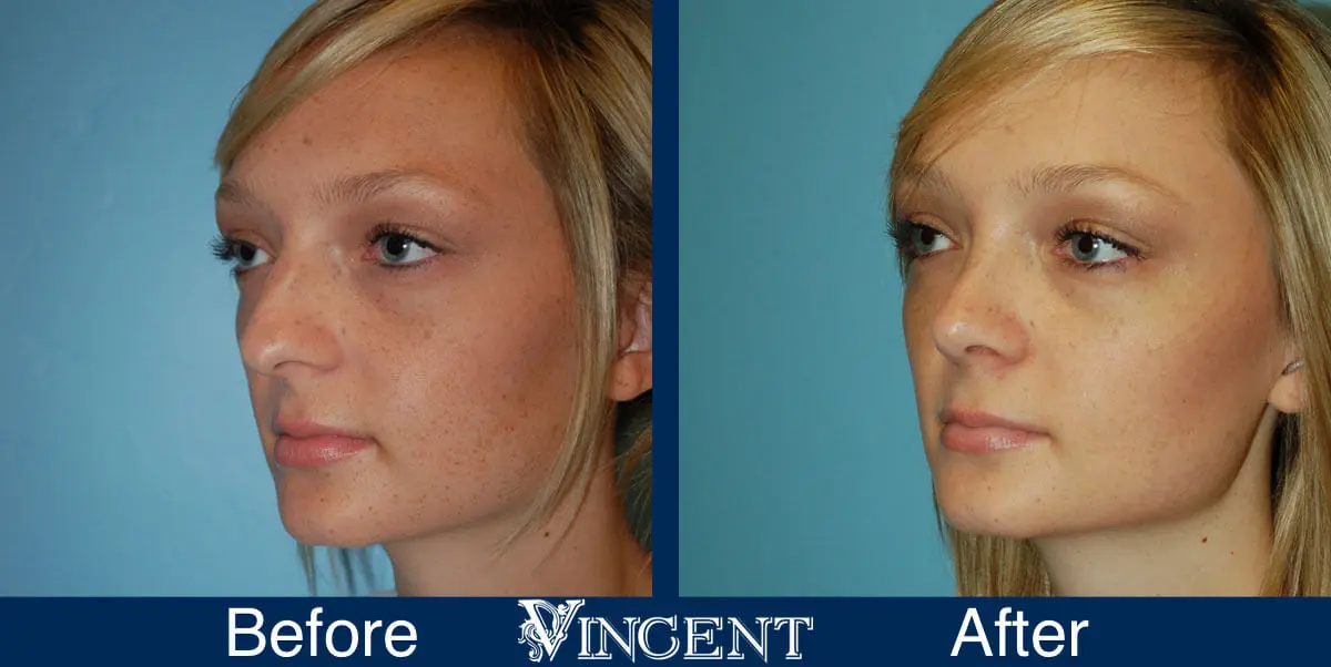 rhinoplasty-nose-job-salt-lake-city-utah-4513-5