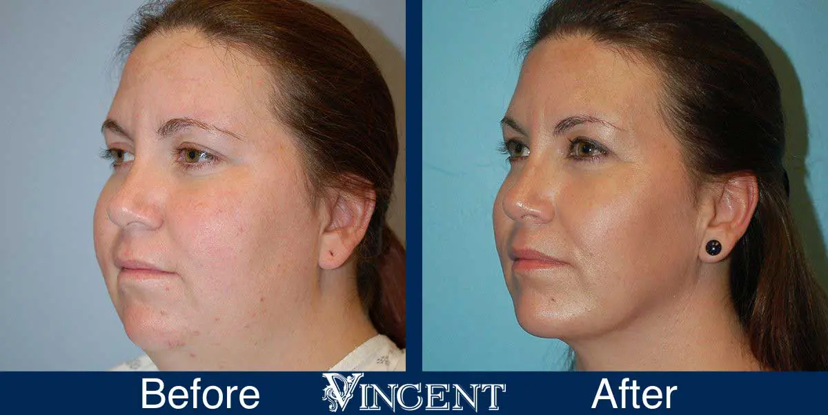 submental-liposuction-before-and-after-utah-vincent-surgical-arts-3001-leftside2
