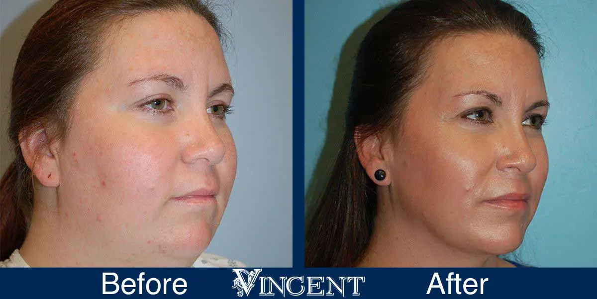 submental-liposuction-before-and-after-utah-vincent-surgical-arts-3001-rightside