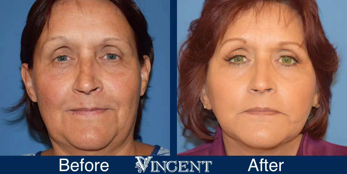 swift-lift-before-and-after-facelift-front-3