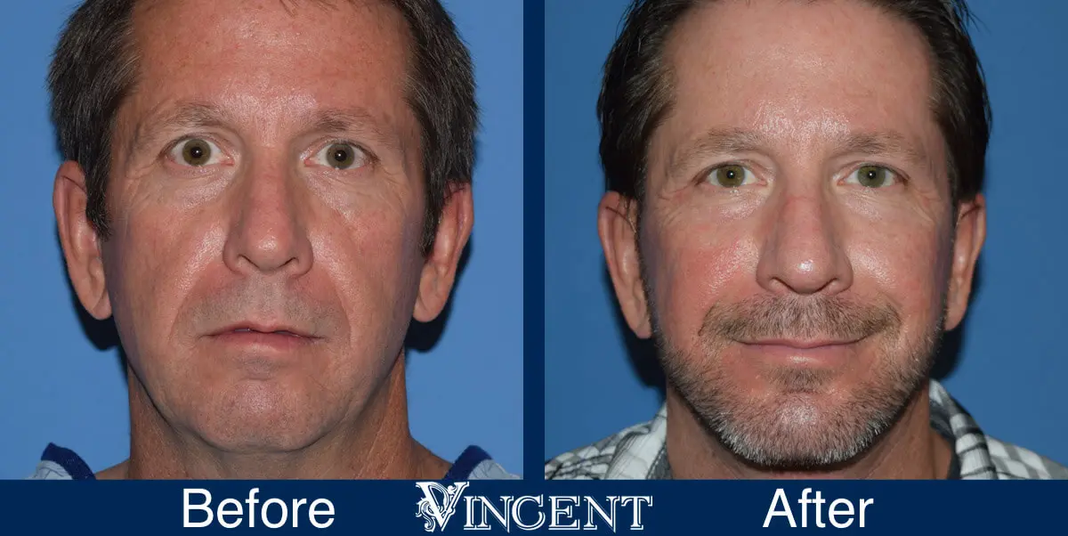 swift-lift-before-and-after-facelift-front